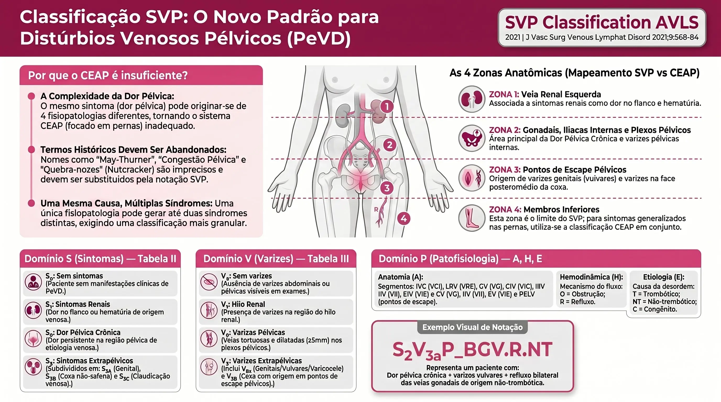 Infográfico: Classificação SVP dos Distúrbios Venosos Pélvicos AVLS 2021. Domínios S (Sintomas), V (Varizes), P (Fisiopatologia). Quatro zonas anatômicas. Tabelas S, V, P completas.