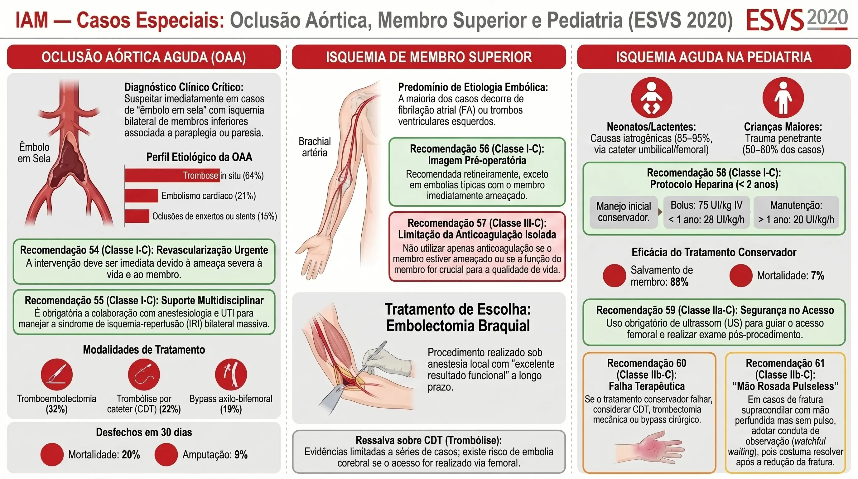 Infográfico: Oclusão Aórtica Aguda, Membro Superior e Pediatria na IAM ESVS 2020. OAA saddle embolus, embolectomia braquial, heparina crianças < 2 anos.