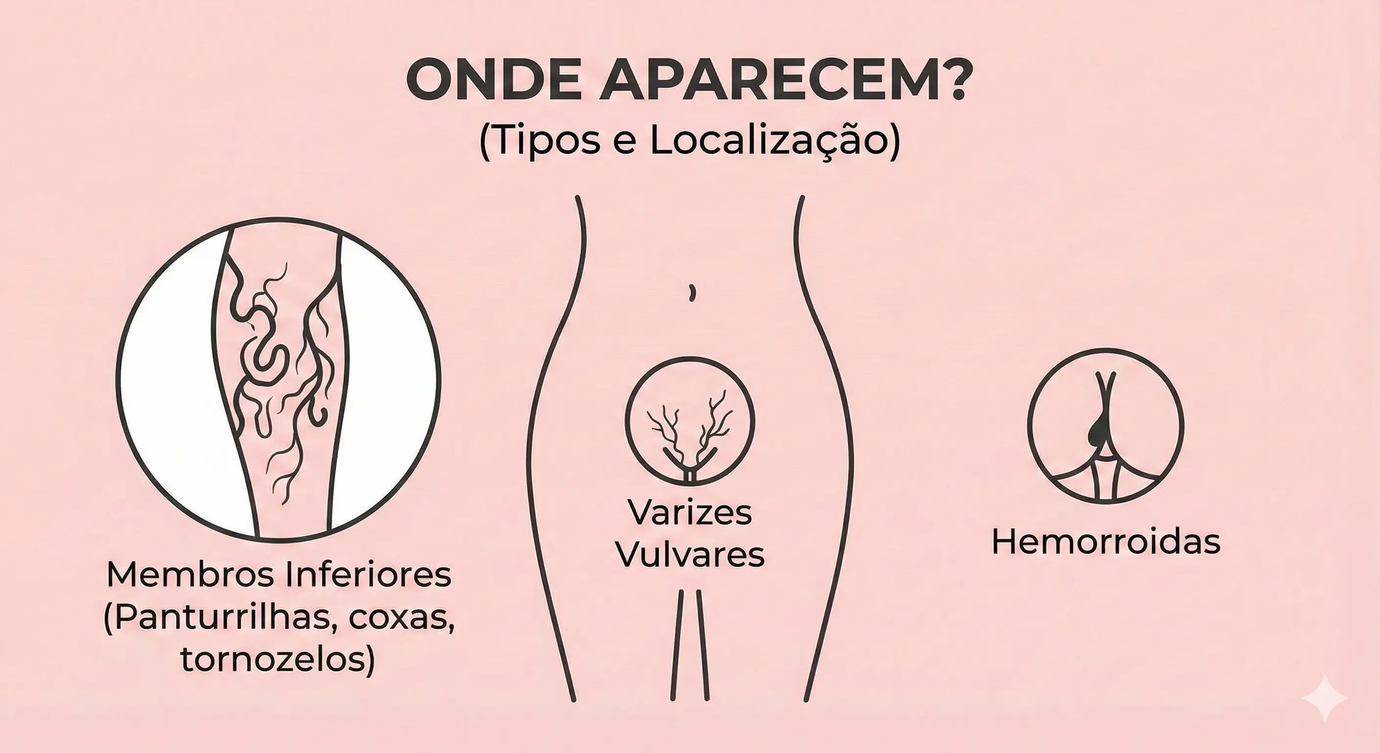 Varizes nas pernas, vulva e hemorroidas