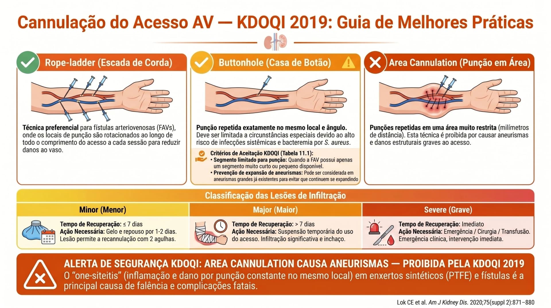 Infográfico KDOQI 2019 — Cannulação do Acesso AV